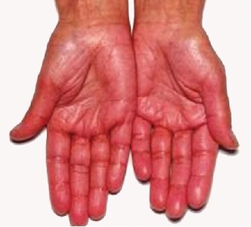 Two hands, palm up are shown. They appear to be more red than is normal.