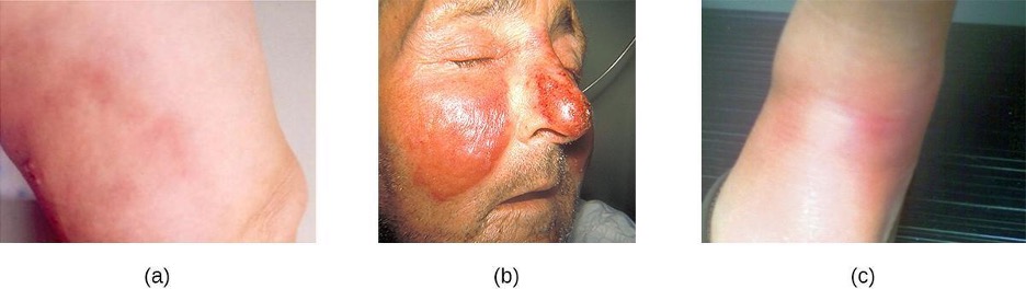 A) a red rash. B) swollen, red regions on the cheeks and nose. C) red lumps on the skin.