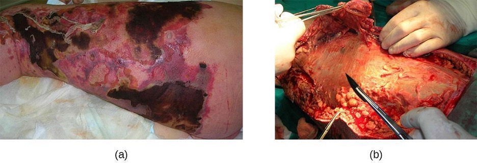 a) skin with large black, grey and red regions. b) Cut skin in surgery.