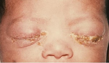 Swollen eyes with discharge.