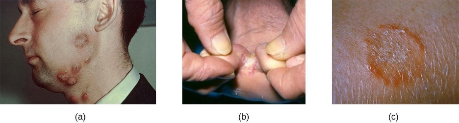a) large red bumps on a cheek and neck. B) white crusty skin on a foot. C) an orange ring on skin.