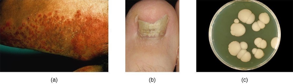 A) a dark, lumpy rash. B) a broken, yellow nail. C) large, white, fuzzy colonies on a plate.