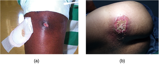 a) a photo of a small inflamed region with a white center. b) A large lesion with white and red.