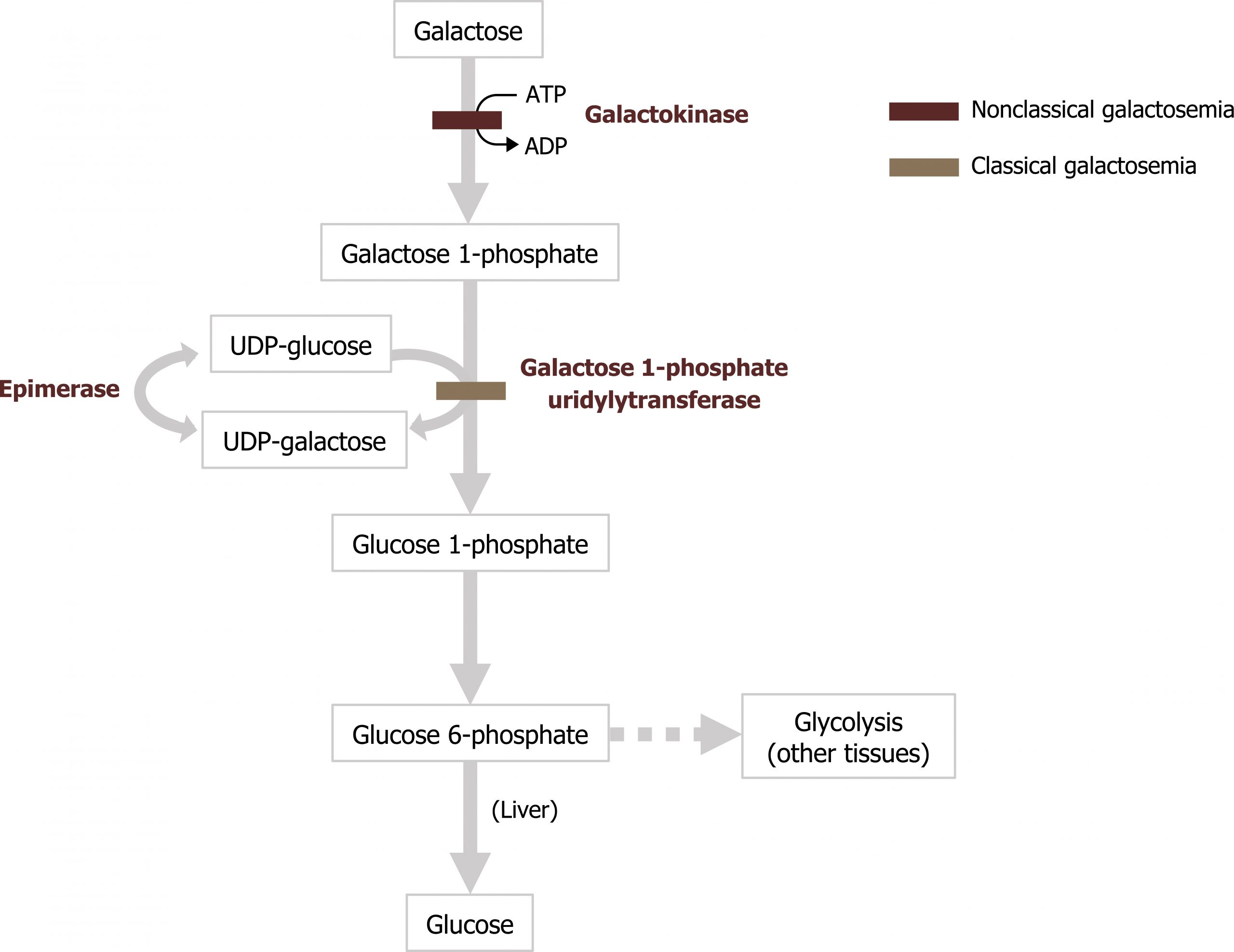 Galactose arrow labeled nonclassical galactosemia with ATP arrow ADP and enzyme galactokinase to galactose-1-phosphate arrow labeled classical galactosemia and enzyme galactose 1-phosphate uridylyltransferase to glucose-1-phosphate arrow glucose-6-phosphate arrow text liver glucose. At classical galactosemia arrow, UDP glucose arrow UDP galactose arrow enzyme epimerase arrow UDP-glucose. Glucose-6-phosphate arrow glycolysis (other tissues).
