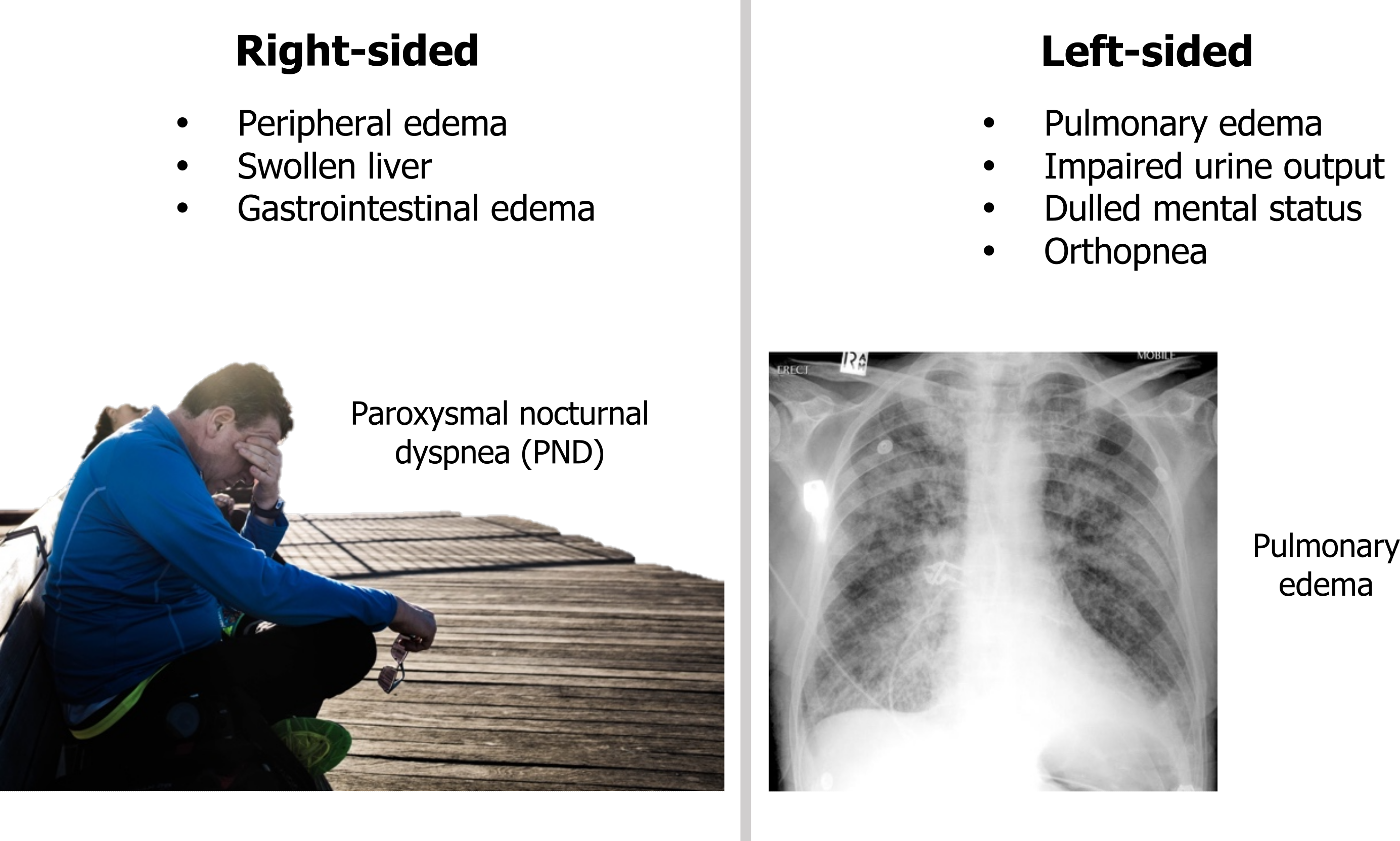 Right-sided: peripheral edema, swollen liver, and GI edema. Figure shows a man sitting upright on the ground leaning his head into his hand and is labeled paroxysmal nocturnal dyspnea (PND). Left-sided: pulmonary edema, impaired urine output, dulled mental status, orthopnea. Figure shows edema in a chest radiograph.