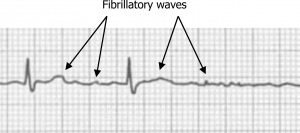 Figure shows lead one of a 12-lead electrocardiogram (ECG). There is an absence of distinct P-waves. Instead there are multiple smaller and irregular waves between normal QRS complexes.