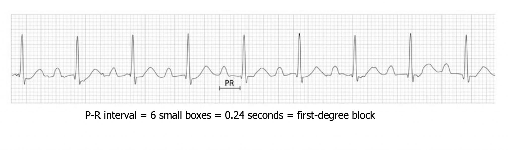 Arrhythmias – Cardiovascular Pathophysiology for Pre-Clinical Students