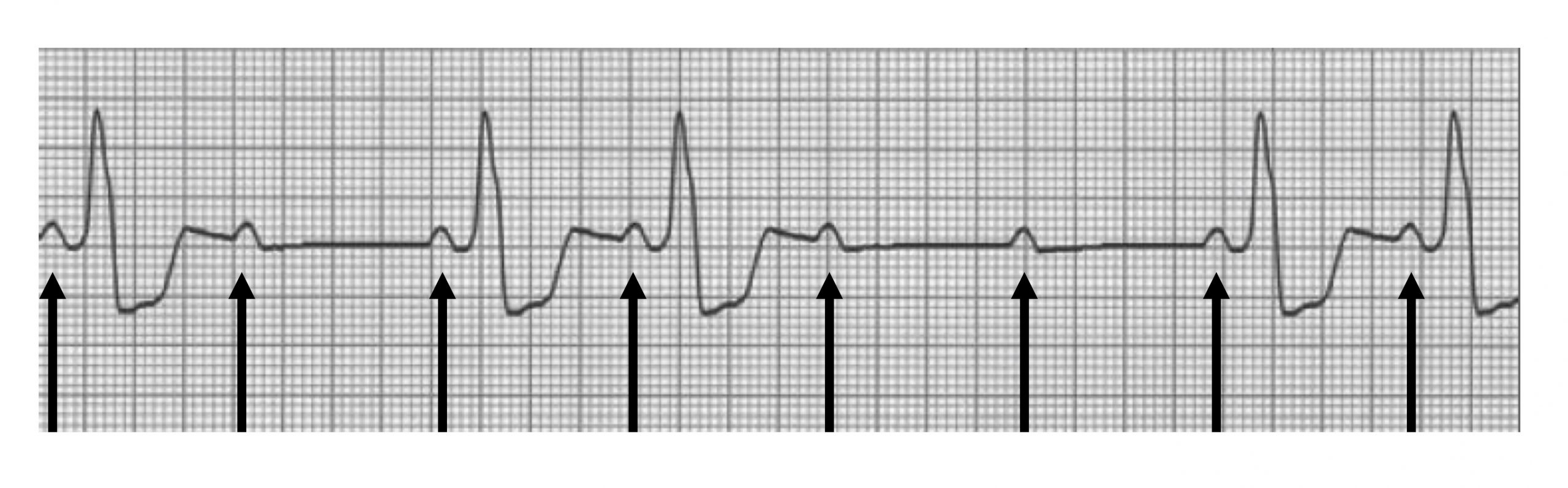 ECG shows P-waves occurring regularly but some are not followed by QRS complexes. The example shows a normal P-wave, QRS complex, T-wave sequence followed by a P-wave without a subsequent QRS complex or T-wave. Then two normal P-QRS-T sequences which are followed by isolated normal looking P-waves without QRS complexes. The ECG then returns to normal structure.