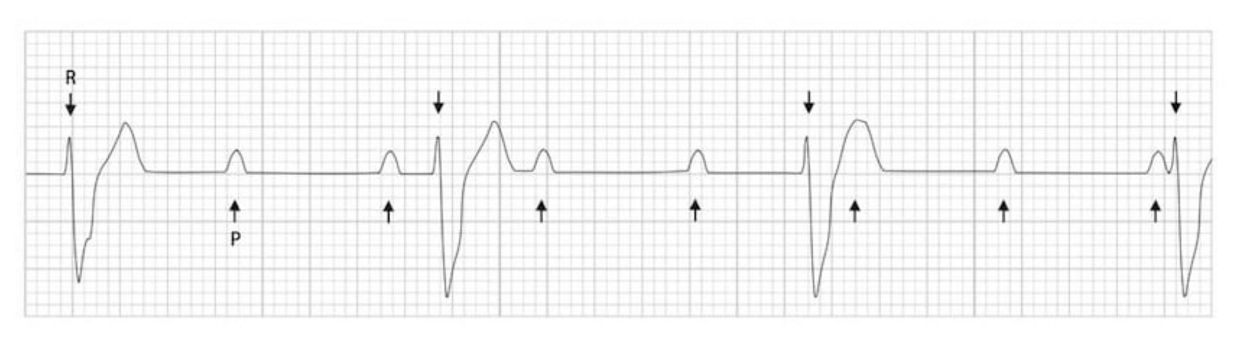 Normal P-waves occur at sinus rate. QRS complexes occur at a much slower rate and are completely independent of the P-waves. Arrows below the ECG point at the P-waves, arrows above the ECG point at the QRS complexes. More frequent arrows below the ECG than above emphasize the difference in atria and ventricular depolarization rates.