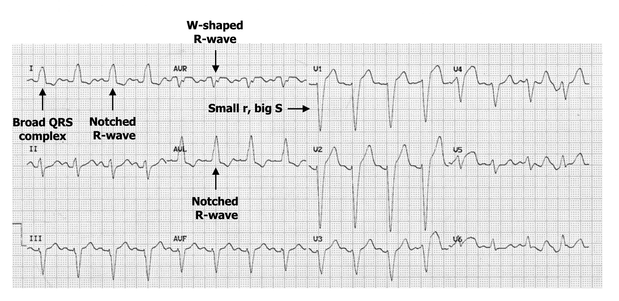 The image shows a 12-lead ECG print out depicting an example of left bundle branch block. Lead 1 tracing shows broadened QRS complexes and the R-wave appears to be notched with a peak followed by another peak. A similar double peaking is seen in the R-waves in the tracing from the AVR lead. As the R-wave is negative in this lead the double peaking makes a W like shape. The S-wave in leads V1 and V2 are negative and very large.