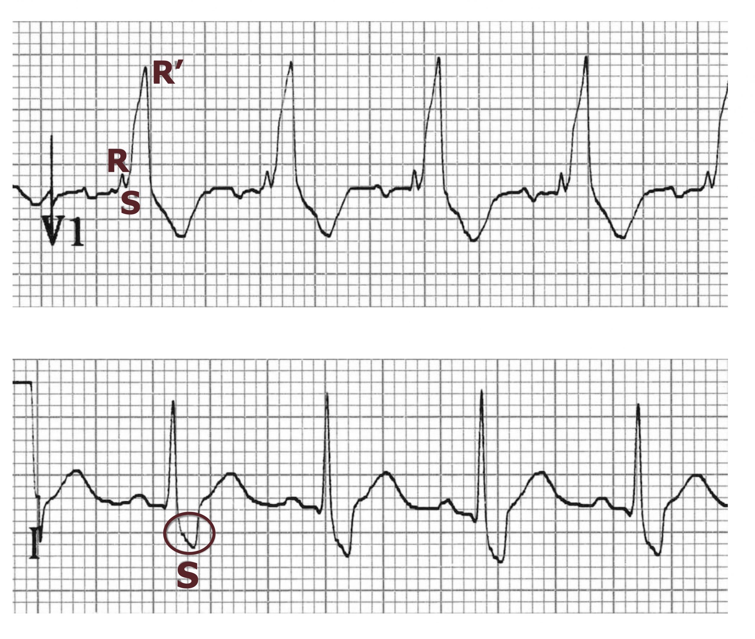 The figure is comprised of two panels, one showing the ECG of lead V1. The other shows the ECG from lead I. The V1 ECG includes a broader wave that has a notched appearance with a peak, followed by another peak. The first peak has been labelled R and the second has been labelled R prime. The lead I ECG shows a slurred S-wave which has a shallower downward slope than a normal S-wave and so the S-wave has a longer duration.