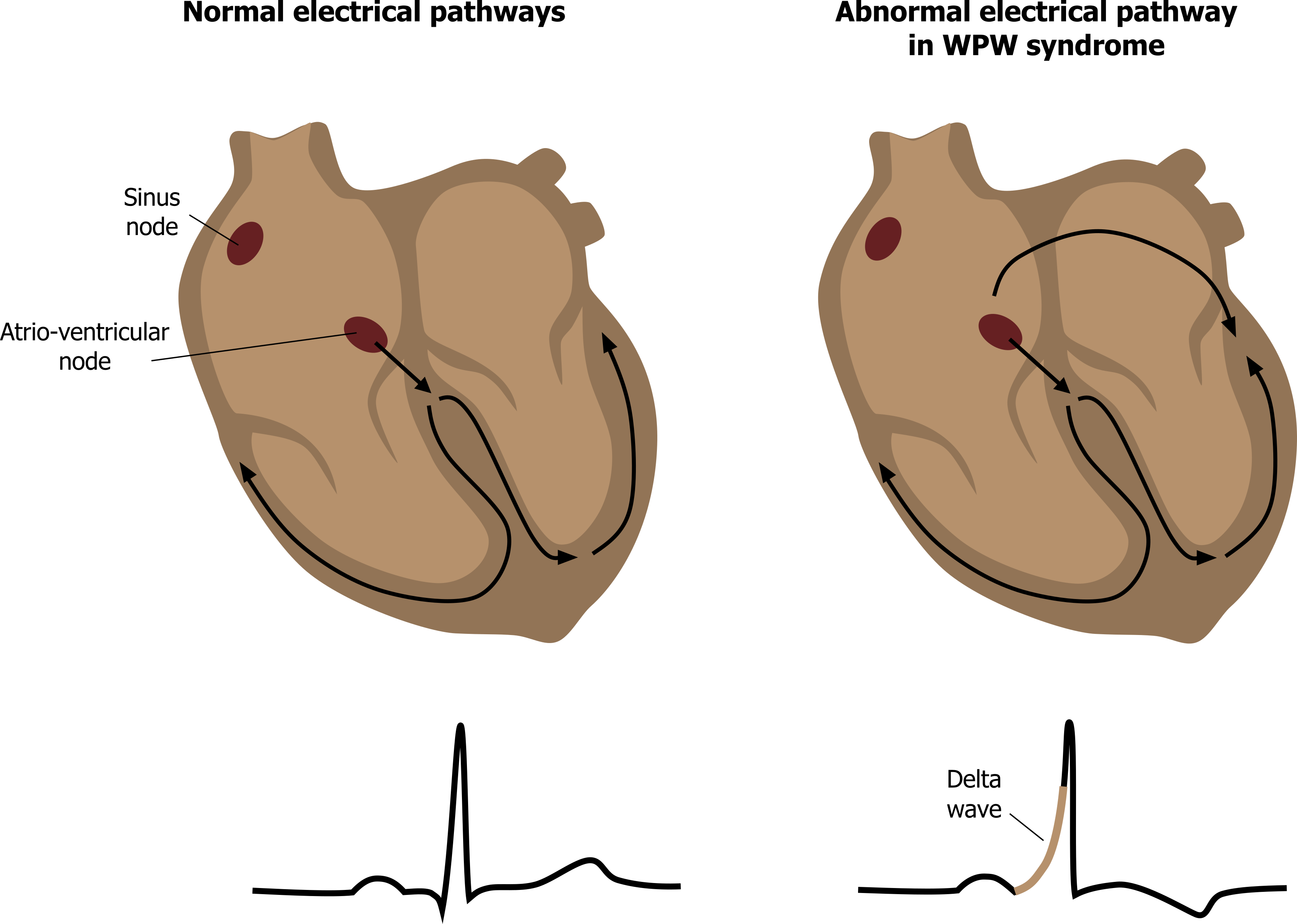 Two diagrams of the conductive pathways of the heart are shown. The first is normal, with an arrow showing normal transition of the action potential through the AV node into and around the ventricular myocardium. The second heart diagram shows two arrows from the AV node - one taking the normal conductive pathway into the ventricles, the other travelling across the atrium and passing through the atrial-ventricular septum through an aberrant pathway into the ventricles. This aberrant pathway causes the WPW syndrome. ECGs below each heart diagram show a normal ECG associated with the normal conductive pathway, but with the WPW pathway the associated ECG shows a delta wave which is seen as a slower rise to the QRS complex compared to the sharp depolarization seen in the normal ECG.