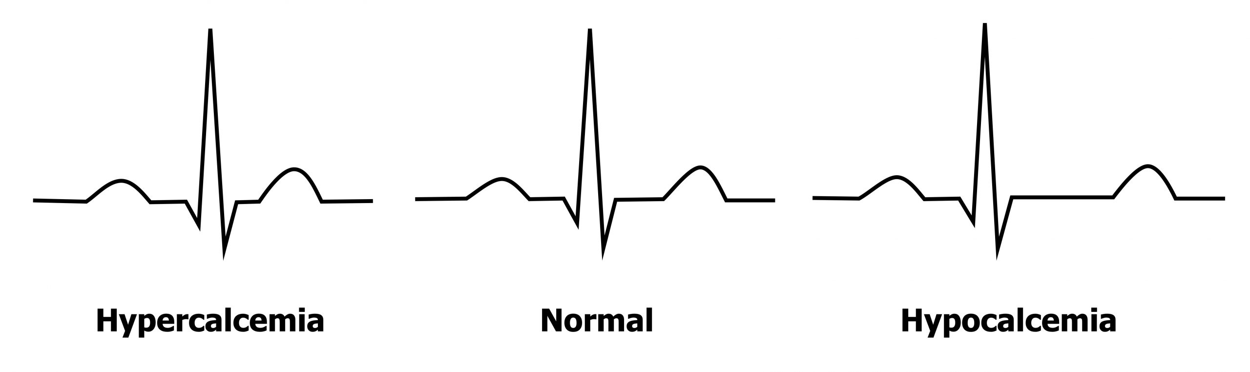 The figure shows three ECGs. The ECGs are typical of hypocalcemia, hypercalcemia, and a normal ECG for comparison. The hypercalcemia ECG shows a shortened Q-T interval whereas the hypocalcemia ECG shows a prolonged Q-T interval compared to the normal.