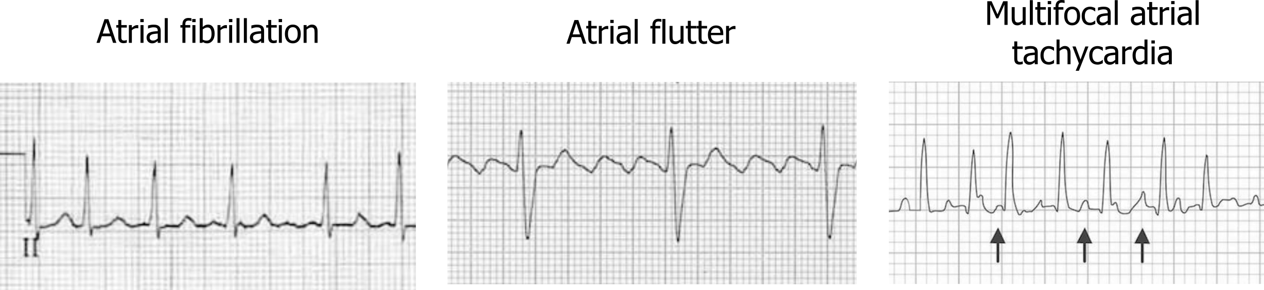 Atrial fibrillation (afib) shows lack of P-waves; atrial fibrillation (aflutter) has regular QRS complexes and sawtooth patterns which resemble P-waves but there are too many of them; Multifocal atrial tachycardia (MAT): P-waves are present but they have different shapes reflecting their different origins in the atrial wall. Each of the P-waves is followed by a QRS complex.