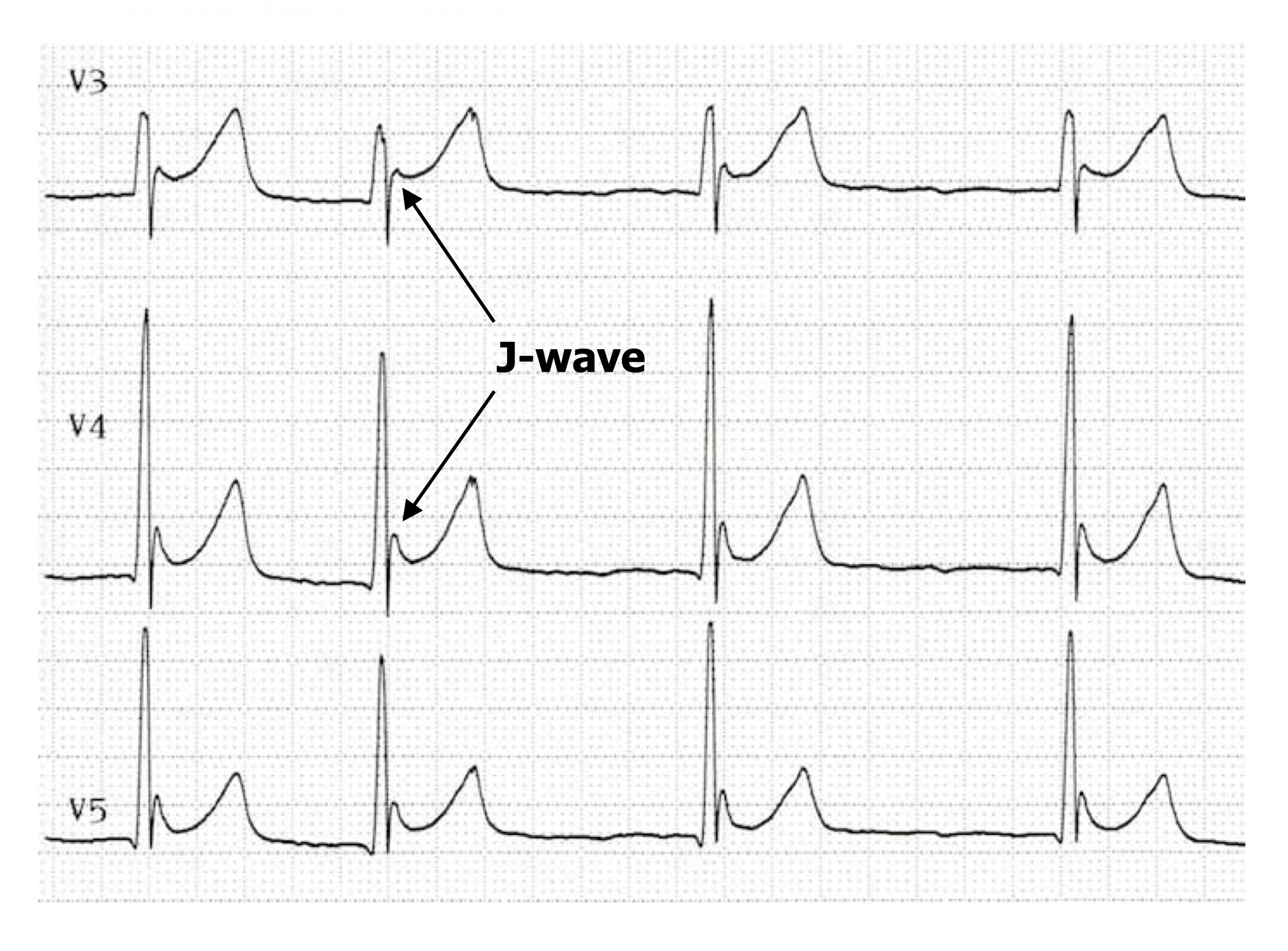 The figure shows ECGs from three leads, (V3, V4, and V5). In each lead a J-wave appears and arrows point to the J-wave in leads V3 and V4. The J-wave consists of an extra, small positive inflection after the R-wave then slopes back to the isoelectric state before the onset of a normal looking T-wave.