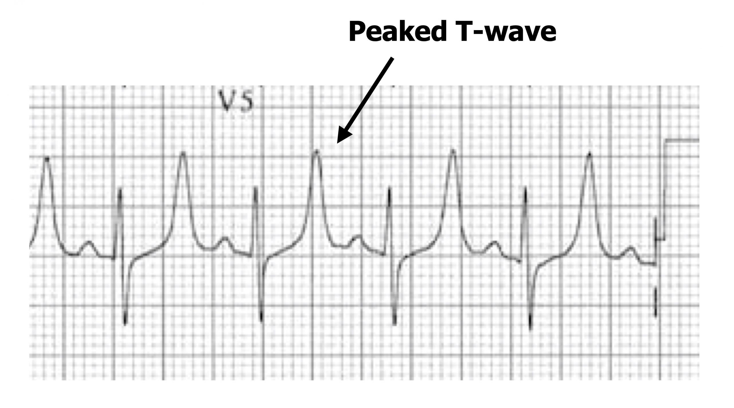 The ECG of mild hyperkalemia shows a relatively normal ECG in lead V5 except for very high T-waves that are peaked and exceed the height of the proceeding R-wave.