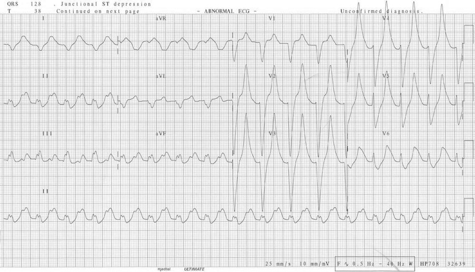 A 12-lead ECG associated with moderate hyperkalemia shows low, long P-waves and diminished R-waves. Conversely the T-waves are very pronounced and they tower over the smaller R-waves in leads V1-3.