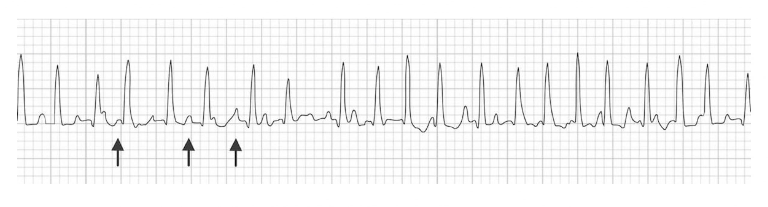 At least three different shapes of P-waves are seen, some small, some broader and some taller. But each one is followed by a QRS complex.