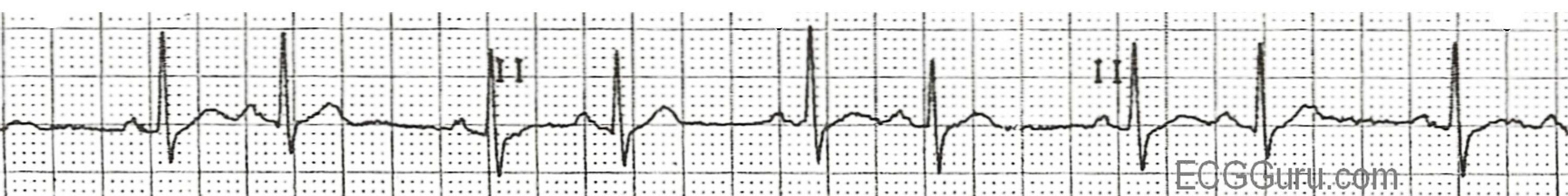 Normal QRS complex is rapidly followed by a premature atrial contraction which leads to another QRS complex. These two beats (bigemenie) are followed by a prolonged gap which is followed by another normal P-wave and QRS complex which again is followed by an abnormal premature atrial contraction (PAC) instigating another QRS complex. This process is repeated resulting in two QRS complexes clustered together all separated by prolonged gaps.