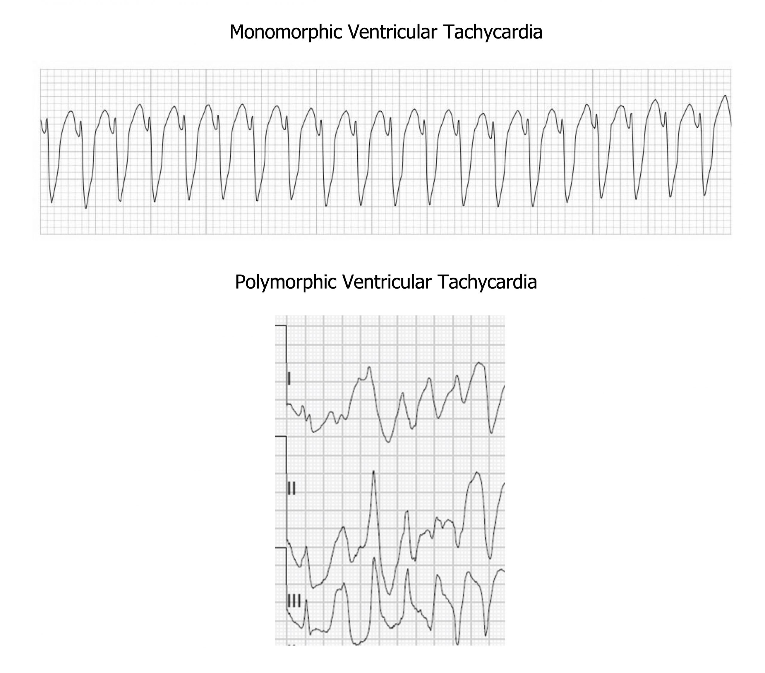 Image shows large, broad complexes with no resemblance to a normal ECG. The complexes are uniform in shape each with a dome peak.