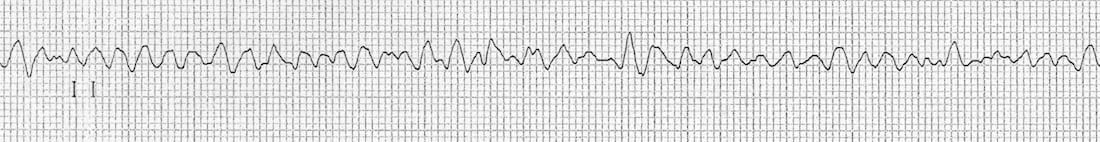 ECG is highly irregular with broad waves that vary in amplitude and shape. The ECG contains none of the features of a normal ECG.