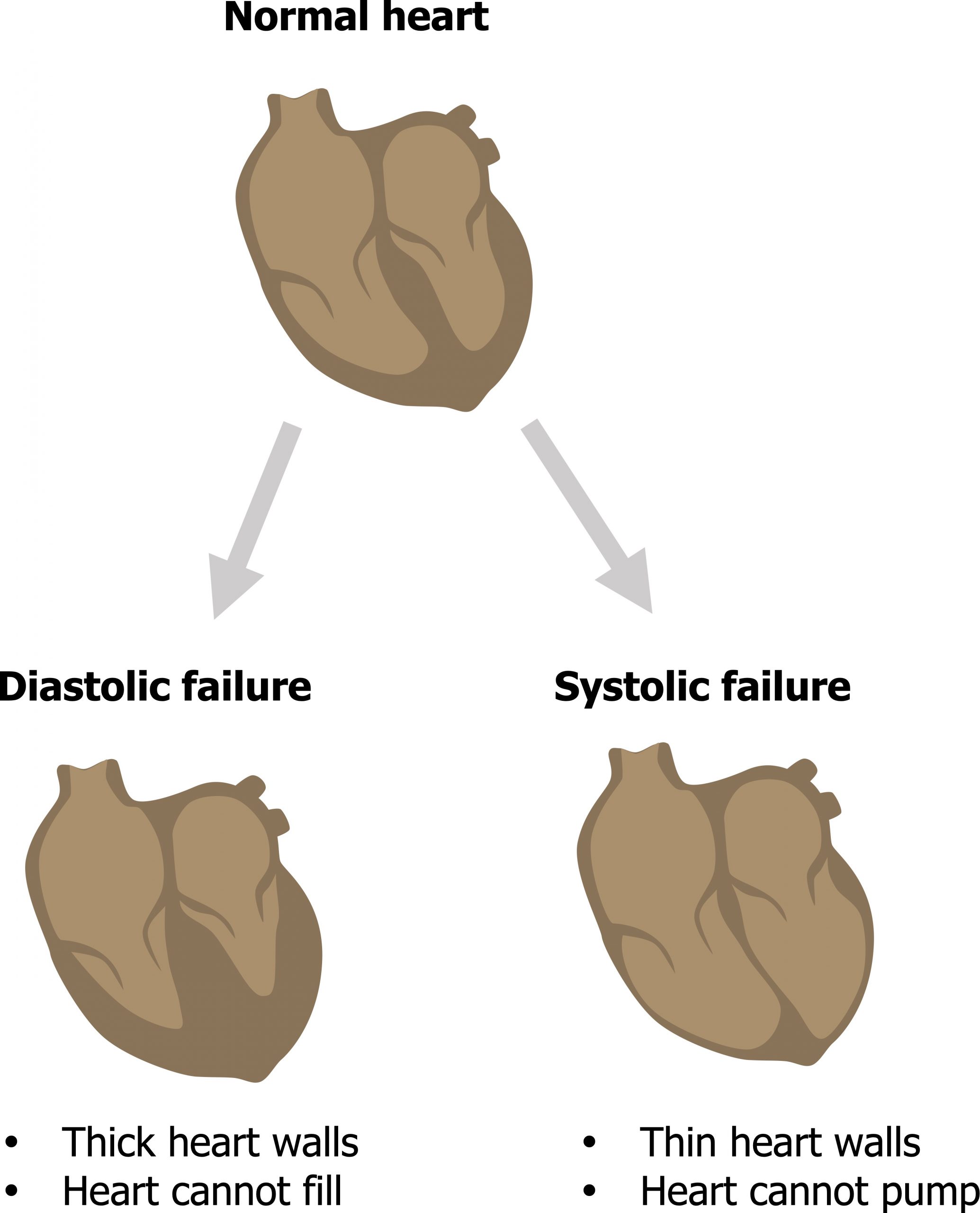 Diastolic failure: thick heart walls, heart cannot fill. Systolic failure: thin heart walls, heart cannot pump.