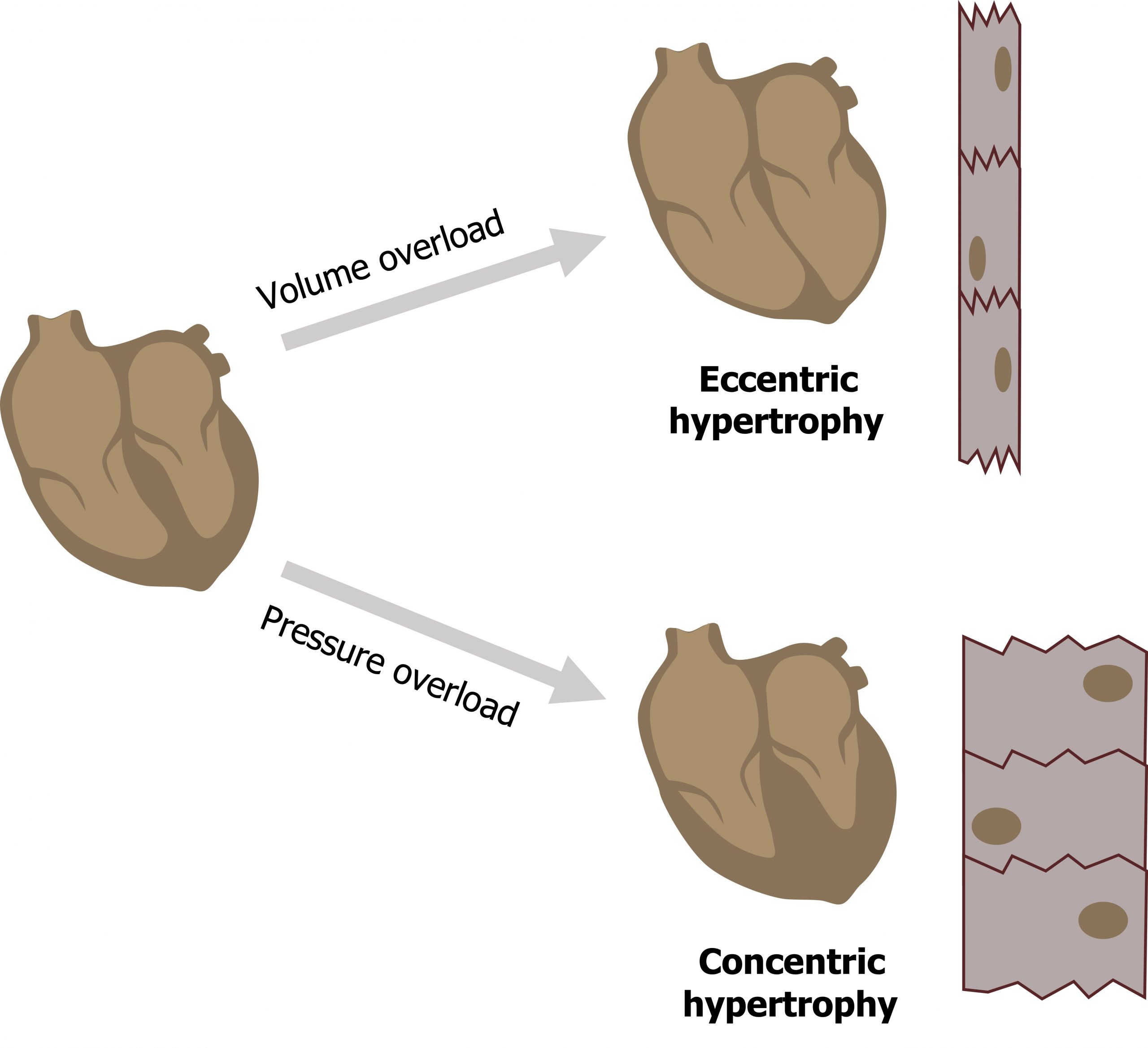 Cartoon of a heart showing the four chambers arrow with text volume overload to a cartoon heart with a thinner heart wall and septum labeled eccentric hypertrophy. 3 cardiac myocytes shown vertically stacked in a skinny rectangle. Cartoon of a heart showing the four chambers arrow with text pressure overload to a cartoon heart with a thicker heart wall and septum labeled concentric hypertrophy. 3 cardiac myocytes shown vertically stacked in a thick rectangle.