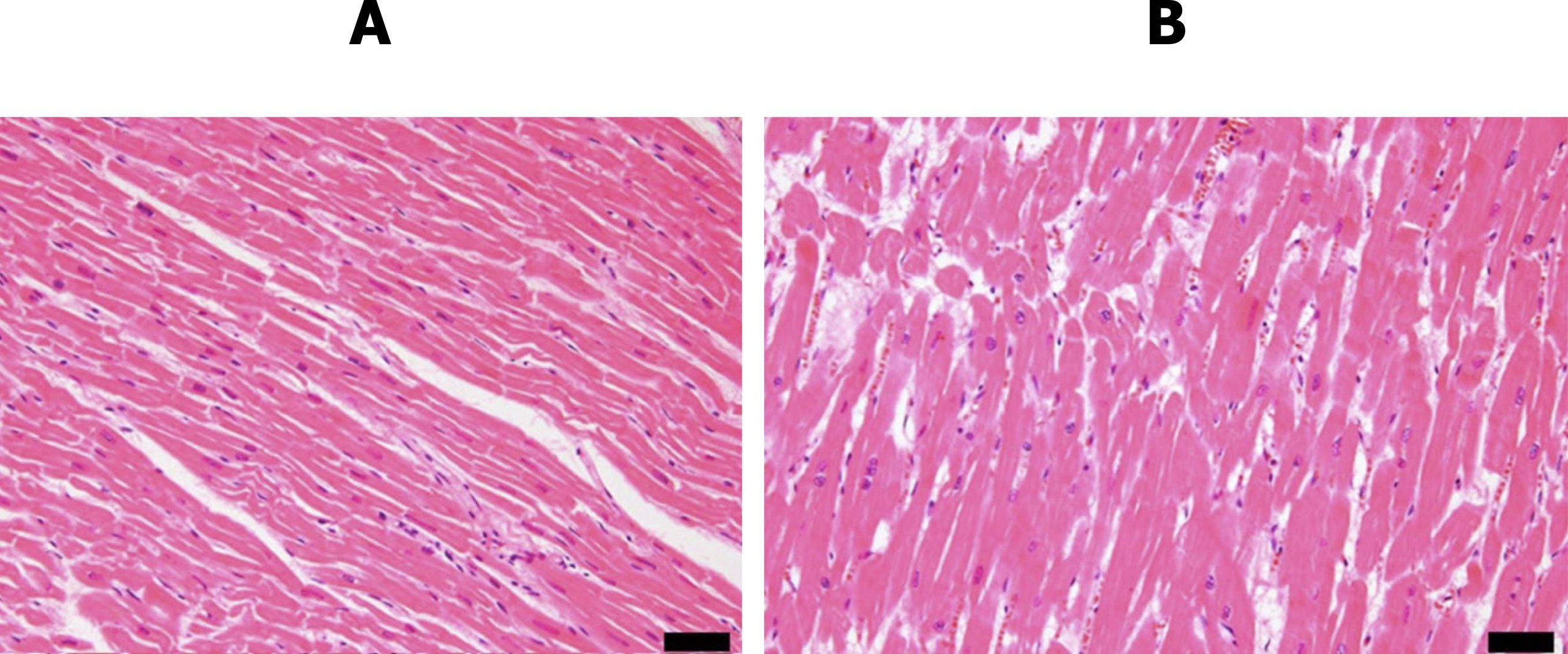 A histological section of normal myocardium is shown with thin, long, myocytes arranged in series and parallel with each other and little space in between. The nuclei of the normal, pink stained myocytes can be seen as small ovid purple dots. In contrast a histological slide of myocardium that has undergone concentric hypertrophy shows broad myocytes that do not have the same organized appearance, spaces between cells are seen and represent connective tissue that is present in this form of hypertrophy. The nuclei of the hypertrophied myocytes are larger and more square.