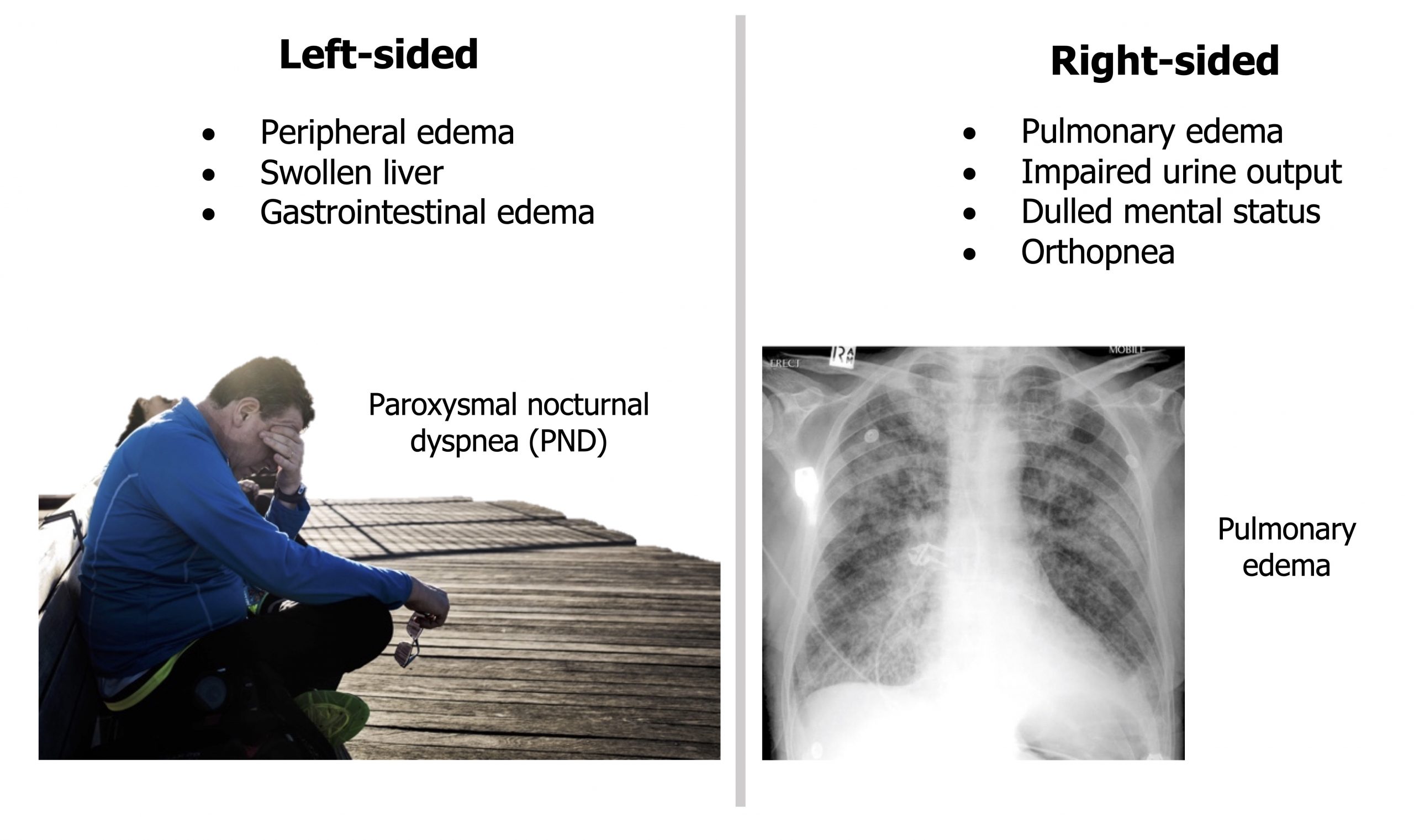 Left-sided: peripheral edema, swollen liver, and GI edema. Figure shows a man sitting upright on the ground leaning his head into his hand and is labeled paroxysmal nocturnal dyspnea (PND). Right-sided: pulmonary edema, impaired urine output, dulled mental status, orthopnea. Figure shows edema in a chest radiograph.