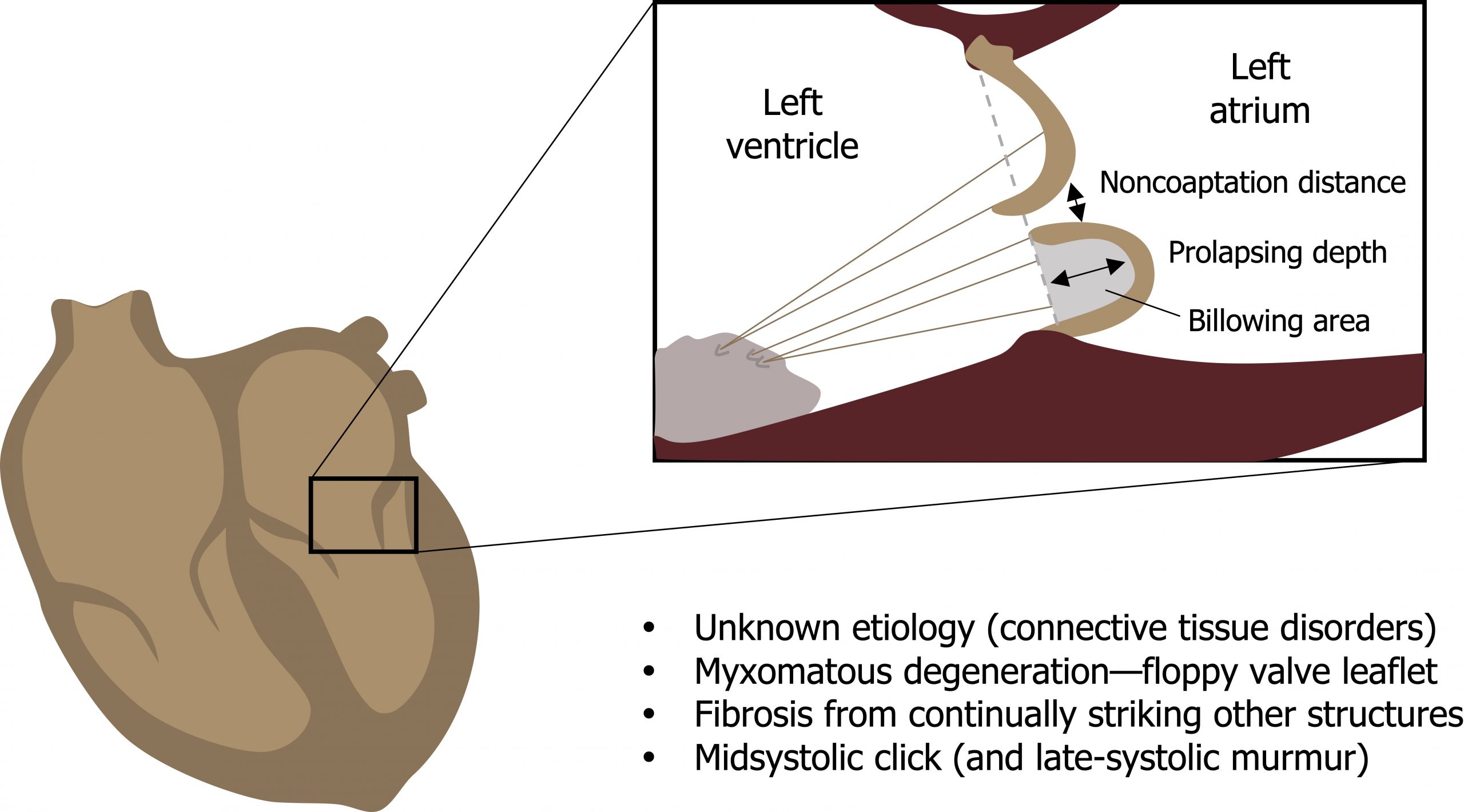 Figure of the heart with a circle around the mitral valve. Figure shows the left ventricle on the left and the left atrium on the right, separated by a vertical dotted line. A curved line on the top of the dotted line and an unconnected arched line on the bottom of the dotted line, with bodies in the left atrium. Arrow between the two lines labeled non-coaptation distance. Arrow from dotted line to top of arched line labeled prolapsing death. Arrow from center of arched line to left atrium labeled billowing area. Text below the figure states: unknown etiology (connective tissue disorders), myxomatous degeneration - floppy valve leaflet, fibrosis from continually striking other structures, and mid systolic click (and late - systolic murmur).