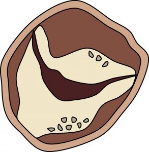 Cartoon diagram of calcium deposits. The mitral valve cartoon uses the same format and color scheme but the circle is only divided into two sections to represent the bicuspid nature of the mitral valve. The calcifications are shown positioned on the annulus. 
