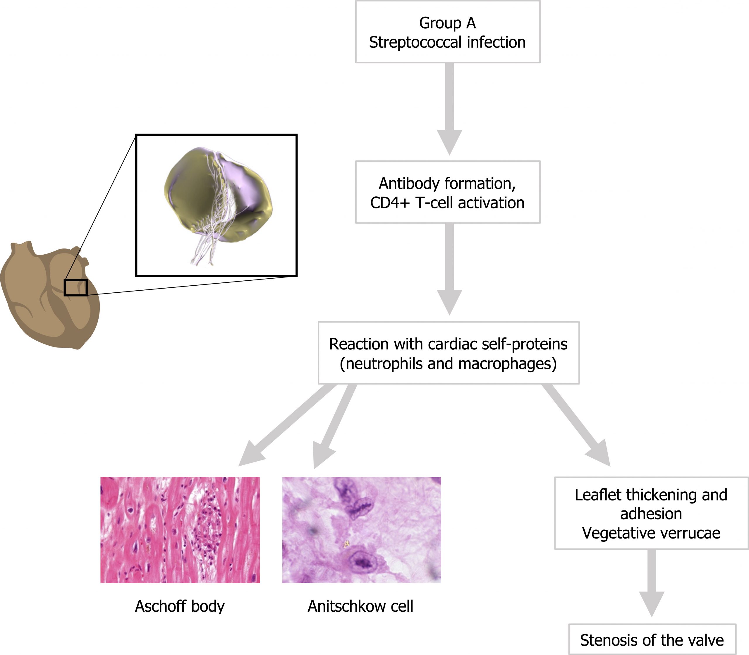 Flow chart beginning with group A streptococcal infection arrow antibody formation, CD4+ T-cell activation arrow reaction with cardiac self-proteins (neutrophils and macrophages) arrows to aschoff body and anitschkow cell. Reaction with cardiac self-proteins (neutrophils and macrophages) arrow leaflet thickening and adhesion vegetative verrucae arrow stenosis of the valve.