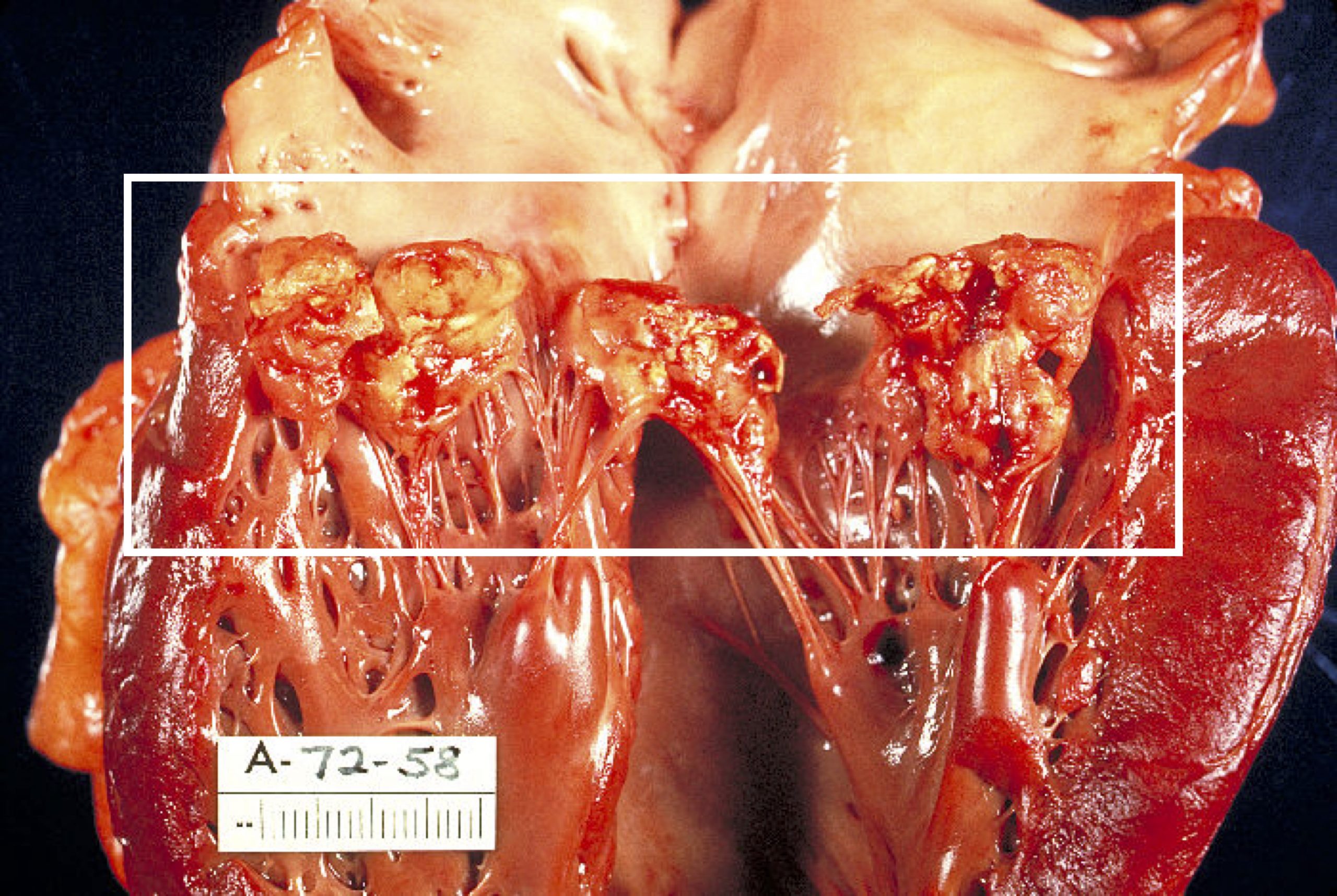 A photograph shows a gross anatomy view of a sectioned heart. The heart is cut in half (coronal plane) at the level of the valves. The valve leaflets have lost their normal smooth appearance and have lumps of inflamed tissue on them giving them a bumpy, rough appearance.