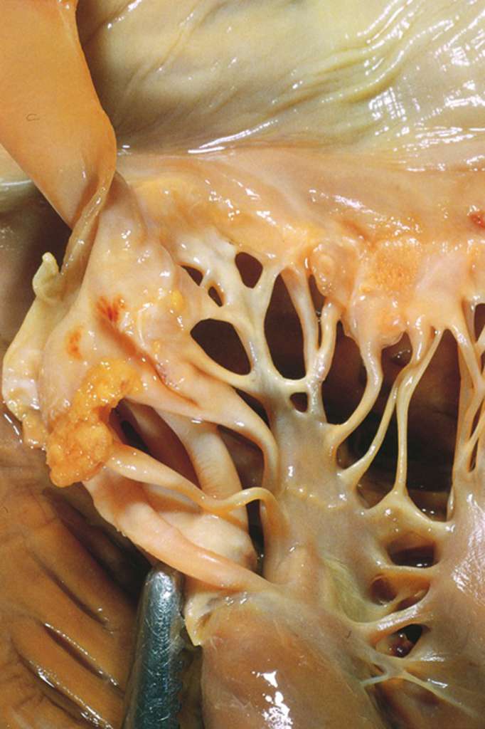 A gross anatomy photograph of a heart valve shows a relatively normal structure with smooth valve leaflets and pale, smooth chordae tendineae. However, on the underside of the leaflets at the junction with the chordae there are patches of rough and raised tissue that are more yellow than the surrounding normal pink/white tissue