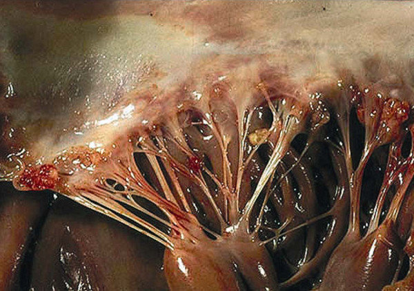 A gross anatomy image shows the chordae tendineae travelling from the myocardial wall to the support valve leaflet. Where the cords attach to the valve leaflet, small wart-like lesions are visible that are red and inflamed.