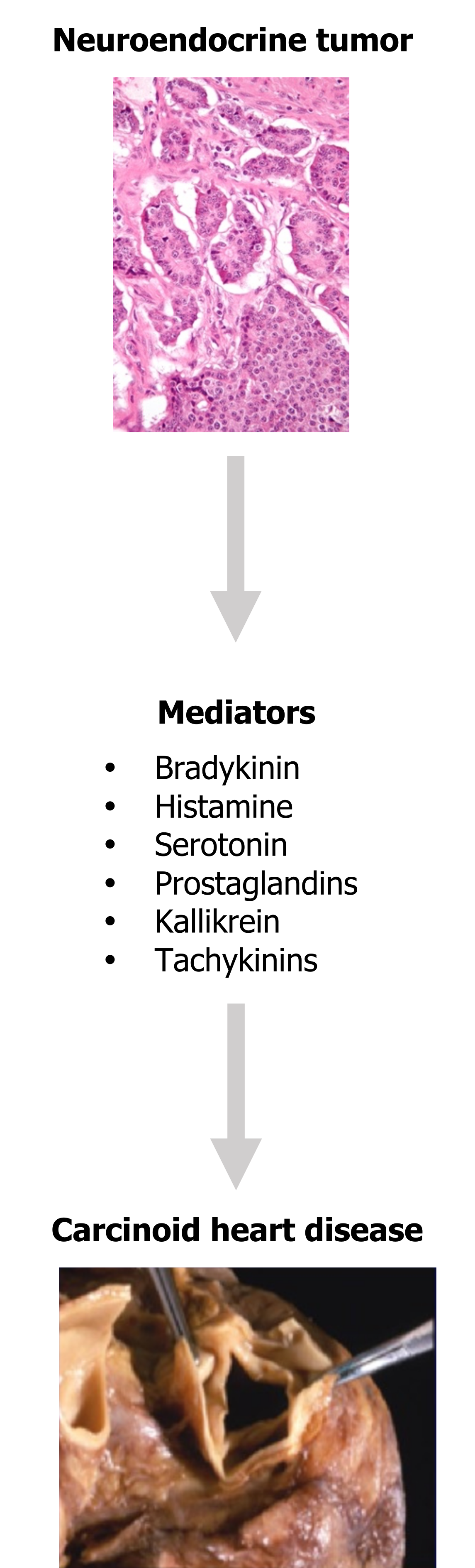 Neuroendocrine tumor arrow with text mediators to include bradykinin, histamine, serotonin, prostaglandins, kallikrein, and tachykinins arrow carcinoid heart disease.