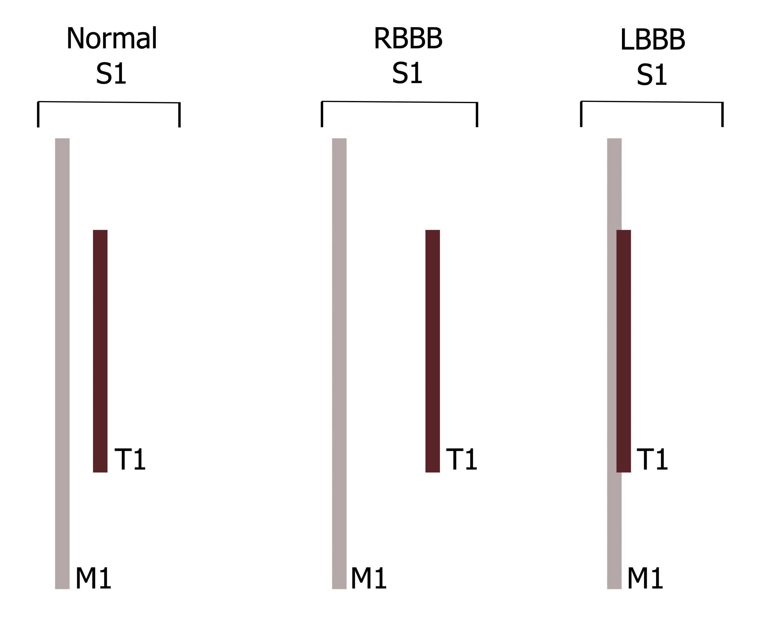 All figures include a large line labeled M1 and a line half the size labeled T1. Normal S1: T1 is centered above M1 with a small space between. RBBB: T1 is centered above M1 with a large space between. LBBB S1: T1 centered directly on top of M1