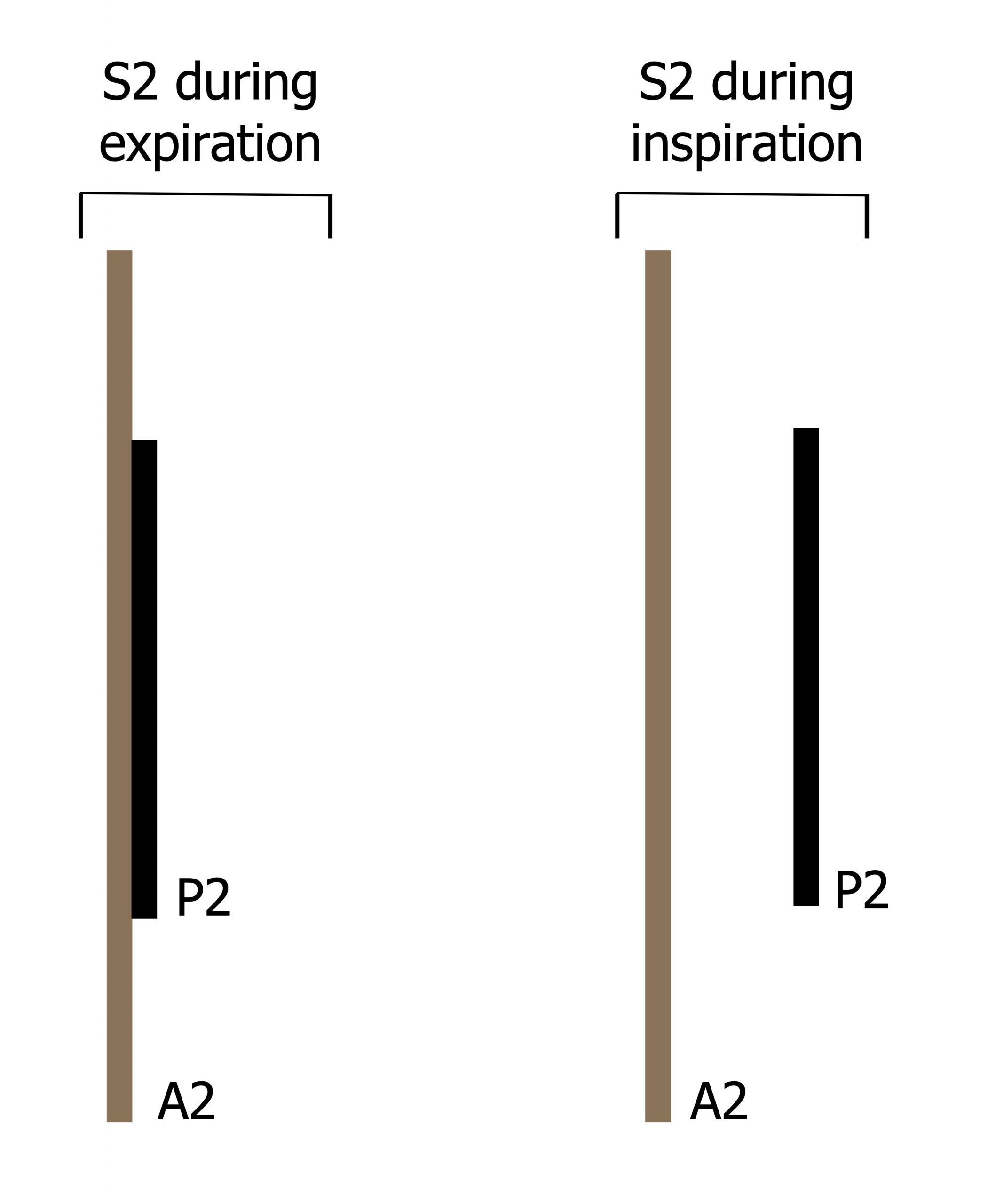 All figures include a large line labeled A2 and a line half the size labeled P2. S2 during expiration: P2 is centered directly on top of A2. S2 during inspiration: P2 is centered over A2 with a large space between