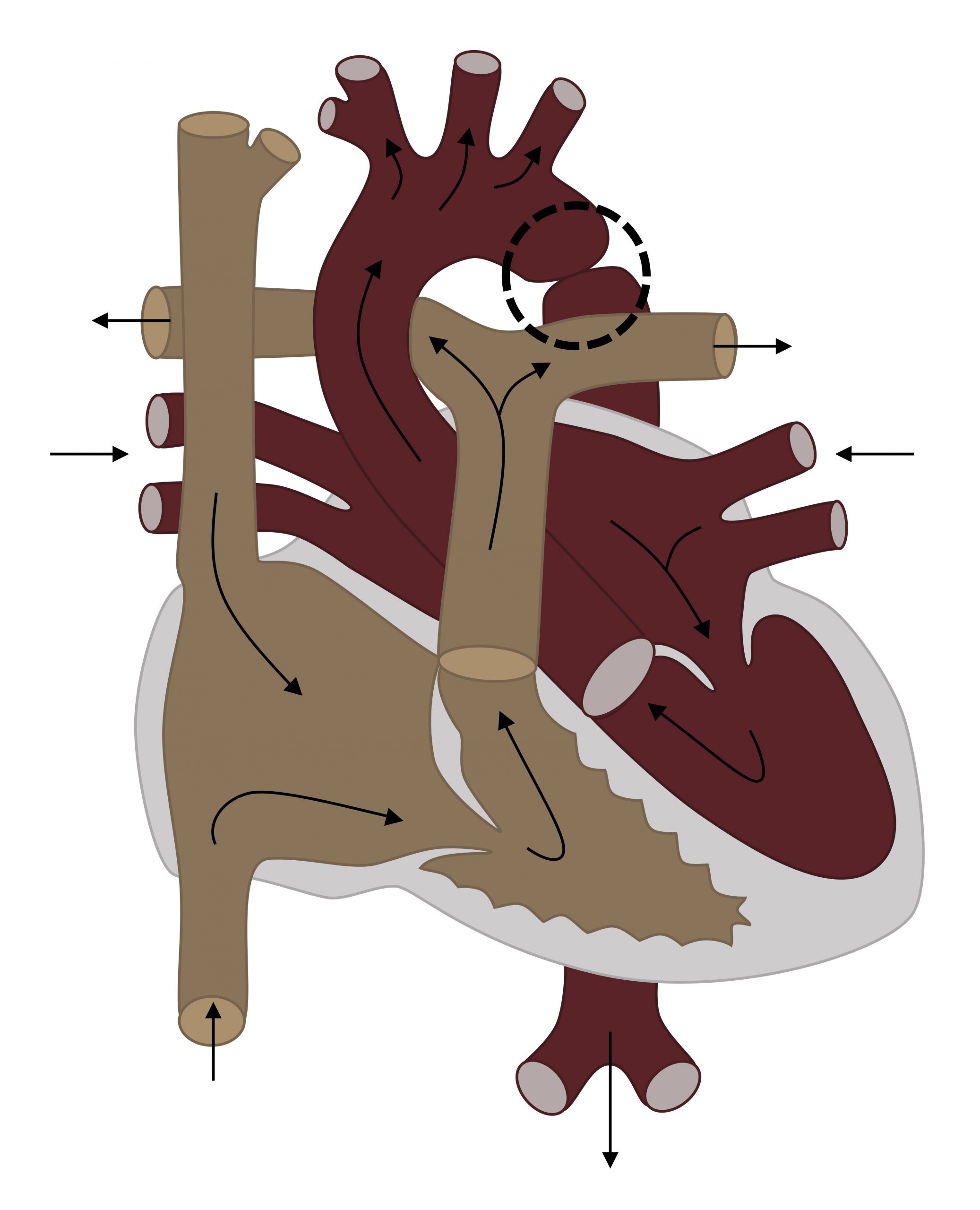 A diagram of the circulatory pathway through the heart shows normal circulatory route until the descending aorta is reached which is 'pinched' signifying a coarctation of the aorta.