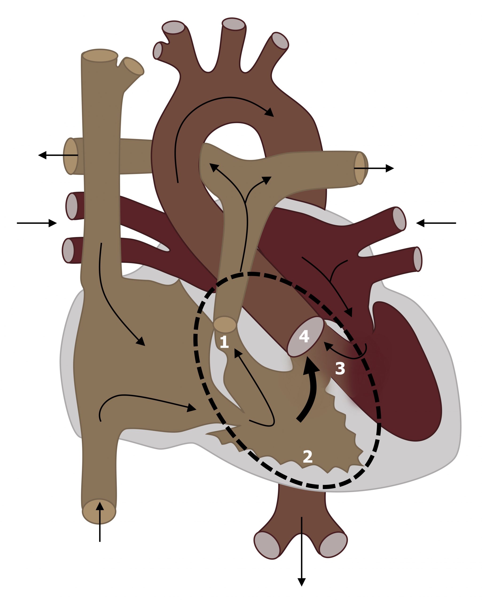 A diagram of the circulatory pathway through the heart has four features of tetralogy of fallot that are labelled with numbers 1-4. Number 1 is placed over the entrance of the pulmonic valve and highlights its narrowed or stenosed appearance. Number 2 is placed on the right atrium wall that is thickened denoting right ventricular hypertrophy. Number 3 is placed over a gap the ventricular septum and represents a ventricular septal defect. Number 4 is over the entrance of the aorta which is positioned near the septal defect and therefore capable of receiving blood from both ventricles