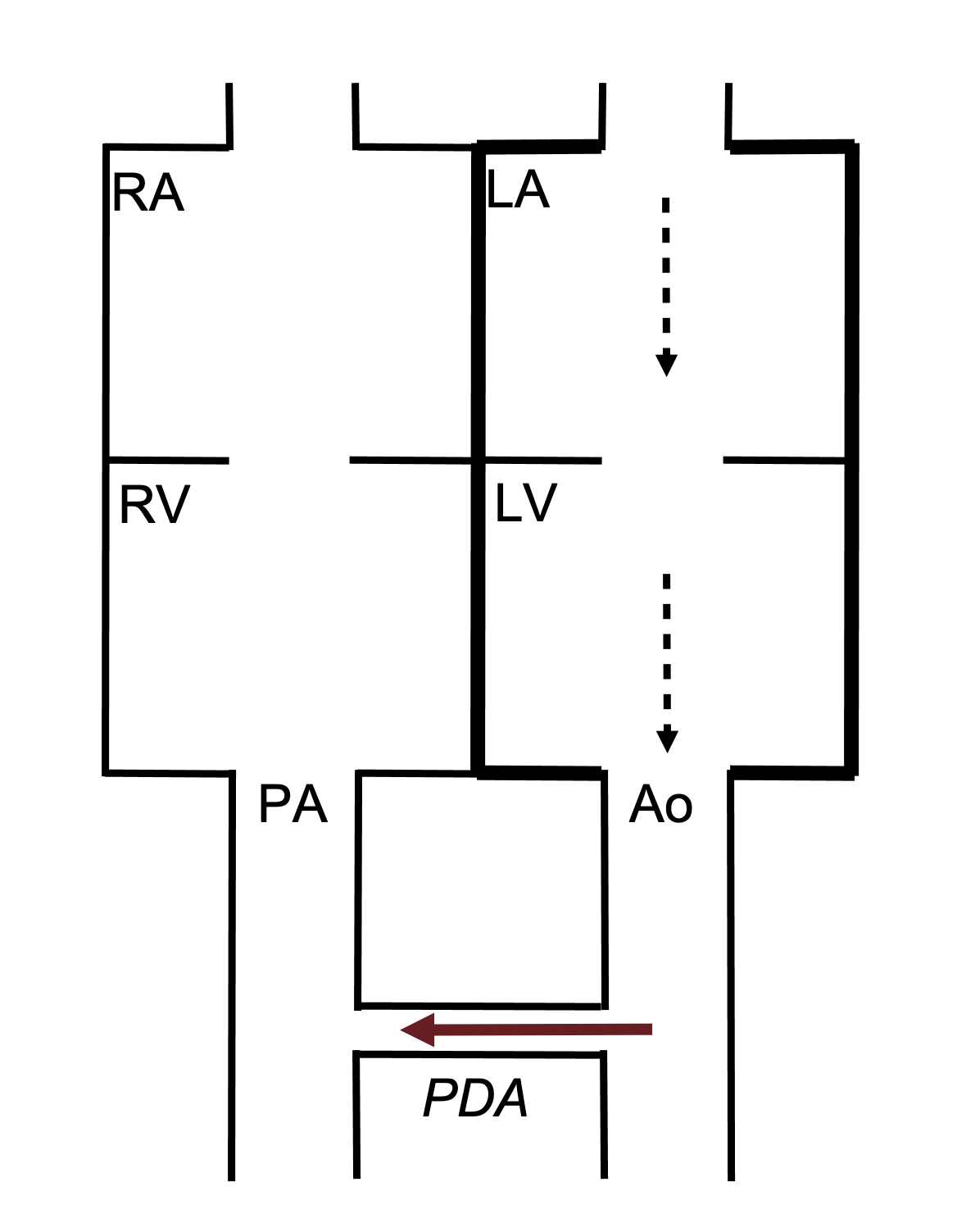 Heart chambers drawn and labeled the same as figure 6.1. Shunt connected Ao and PA labeled PDA with arrow pointing to PA.