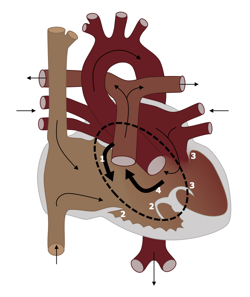 A diagram of the circulatory pathway through the heart is labelled with the numbers 1-4. Number 1 is positioned over the atrial septum and indicates the presence of an atrial septal defect. A think black arrow passes through the atrial septal defect to indicate the passage of blood from the left atrium into the right atrium. The number 2 is placed over the tricuspid valve which have defective leaflets that do not meet, similarly the number 3 is placed over the mitral valve which also has defective, incompetent valves. The number 4 is placed over a large ventricular septal defect - a thick black arrow passes through the ventricular septal defect and into the pulmonary artery, indicating the passage of blood from the left ventricle back into the pulmonary circulation. Other deviations from a normal heart structure include very small ventricular chambers and large atrial chambers. Overall the structure of the heart is beginning to look like one large single chamber instead of four, distinct, valved chambers.