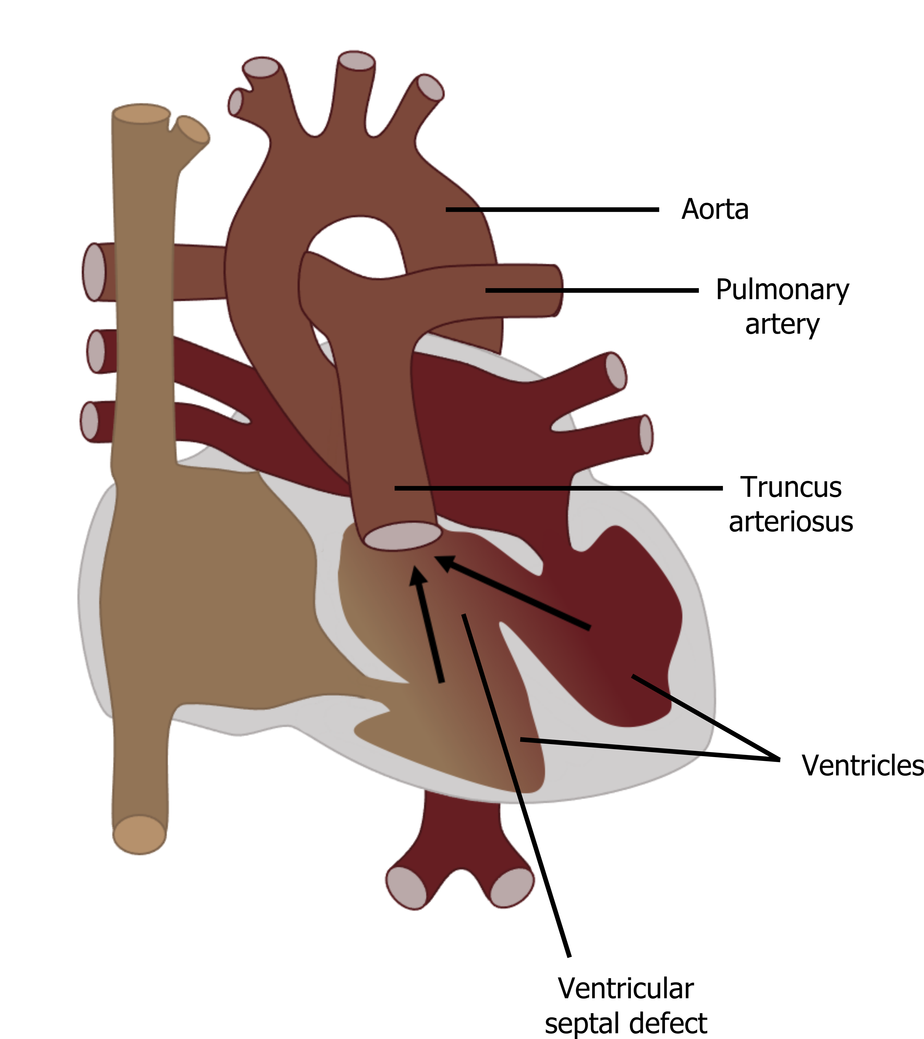 A diagram of the circulatory pathway through the heart is labelled with 'truncus arteriosus'. The label points to a single vessel made of a combined pulmonary artery and aorta. Also present is a ventricular septal defect. The relative positions of the truncus arteriosus and septal defect means blood from both ventricles can simultaneously enter the single vessel and this is indicated by two arrows that lead from the two ventricular chambers into the single vessel.