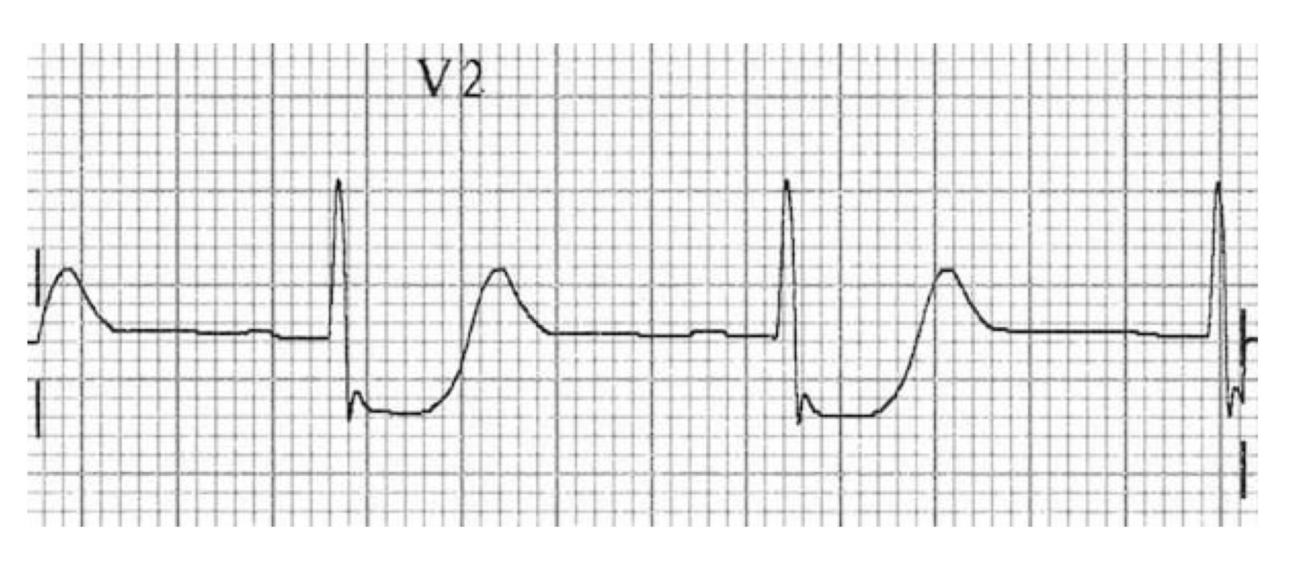 Lead V2 of an ECG is shown with two complete depolarizations. There is distinct depression of the S-T segment which appears much lower than the isoelectric baseline indication of a posterior infarction.