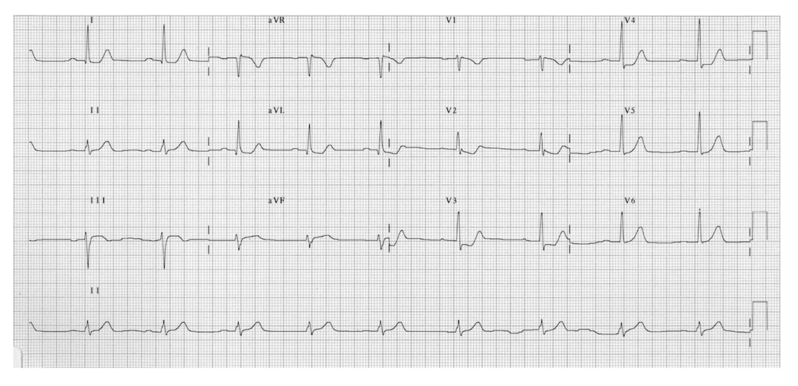 All leads of a 12-lead ECG are shown to illustrate the consequences of an posterior wall MI. There is S-T depression in V1-V4. Posterior Leads V7-V9 are not shown, but would confirm a posterior wall infarction if they included S-T elevation.