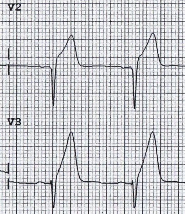Lead V2 and V3 ECGs show a downward orientation QRS complex followed by an abnormally large, positive T-wave.