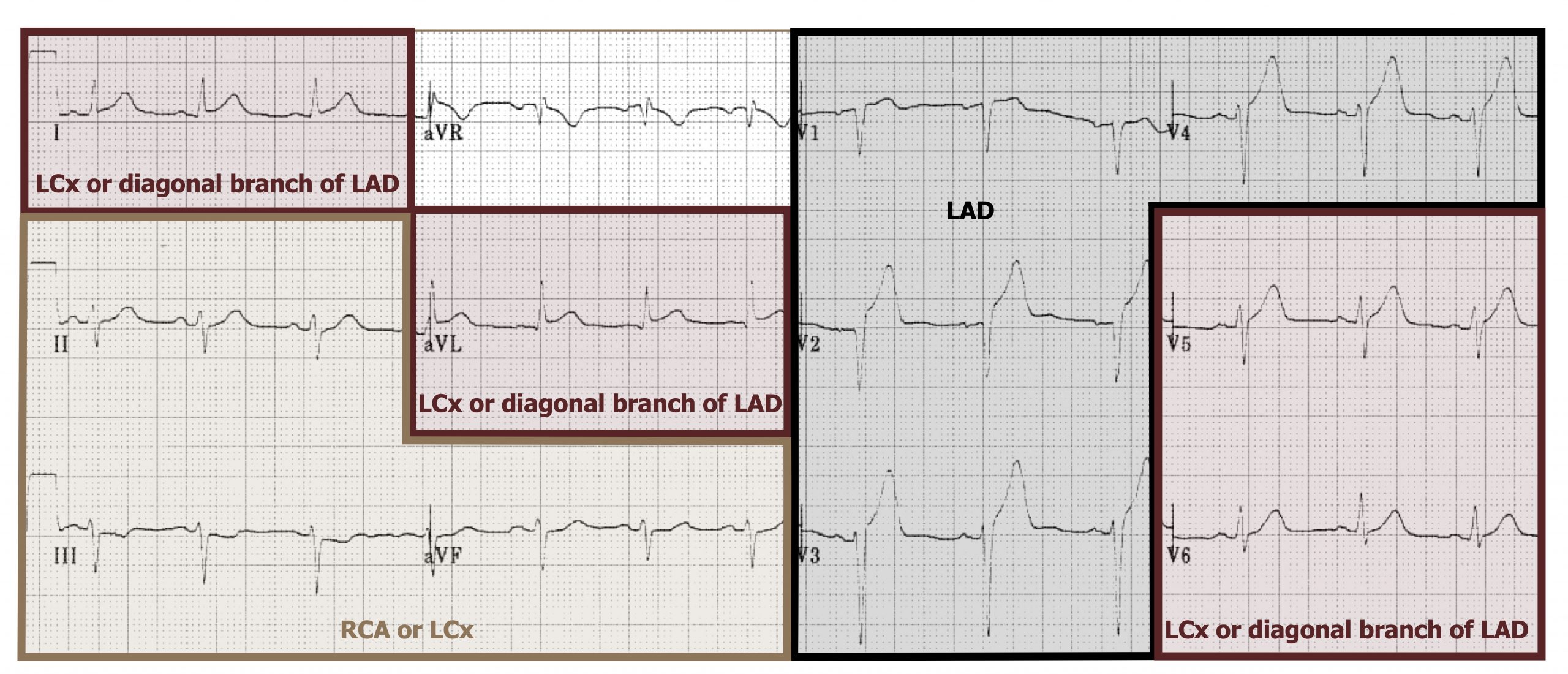 I: LCx or diagonal branch of LAD. II, III, and aVF: RCA or LCx. aVL: LCx or diagonal branch of LAD. V1, V2, V3, V4: LAD. V5, V6: LCx or diagonal branch of LAD.