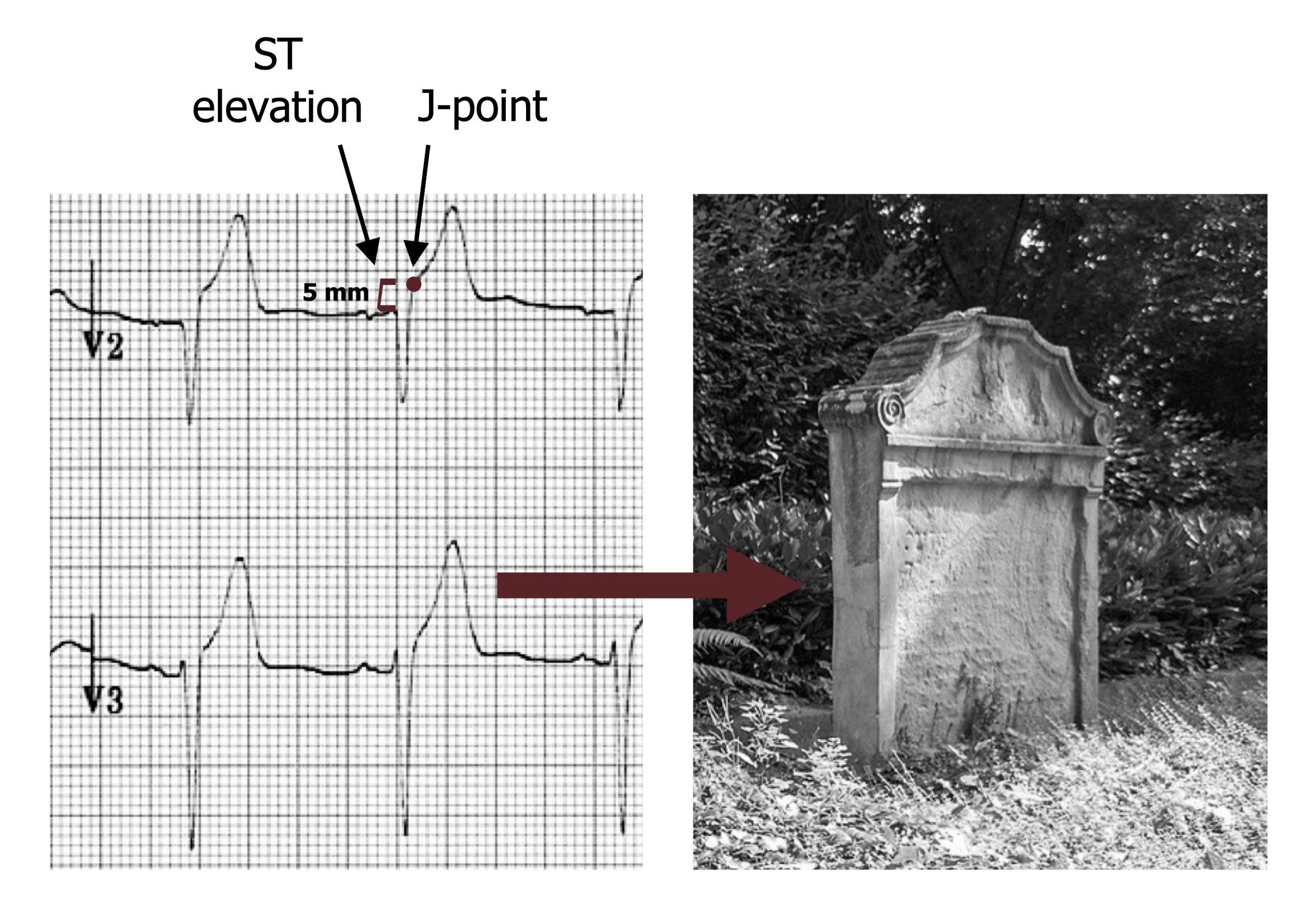 Leads V2 and V3 of an ECG are shown with two complete depolarizations. In both leads there is evidence of ST elevation and a measurement bar shows that the elevation is 5 mm. The elevated ST segment is labelled. Also labelled is a distinct J-point where the ascending portion of the S-wave transitions into the T-wave. The T-wave is tall and broad and has taken on a tombstone appearance. A photograph of a tombstone is shown next to the ECG, the tombstone has a rectangular shape with a curved top.