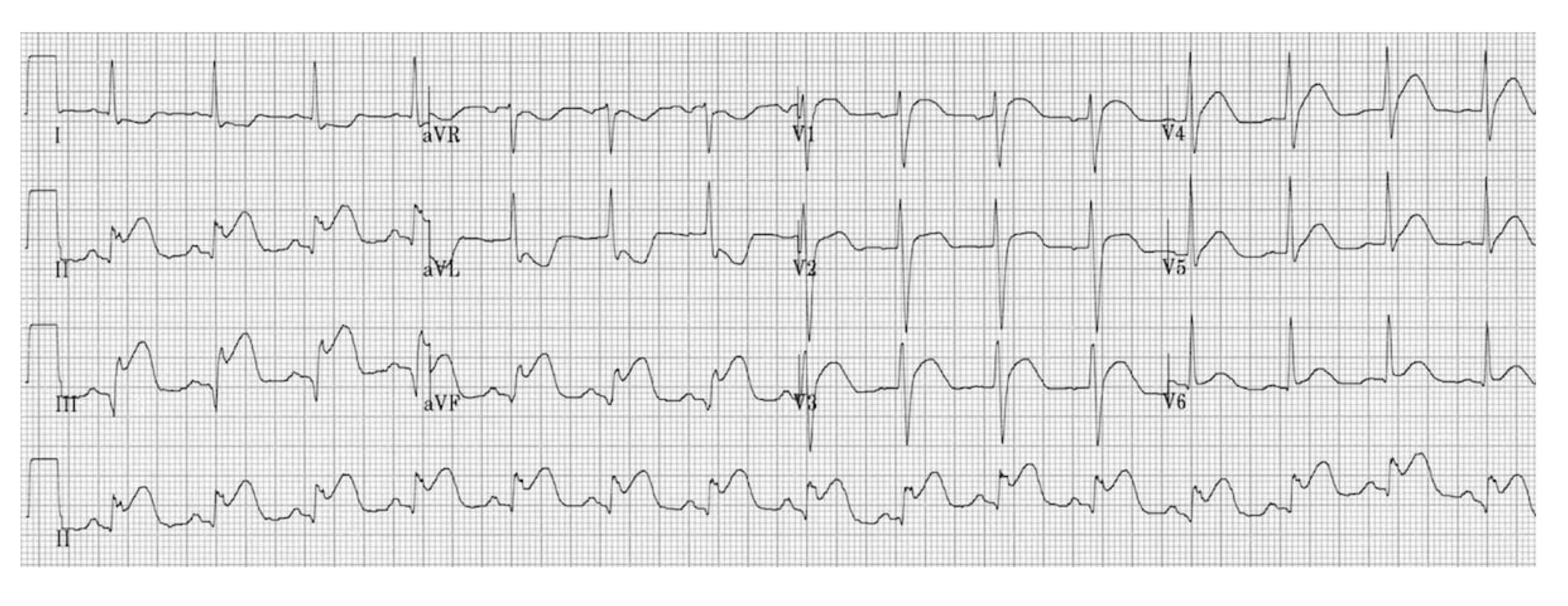 All leads of a 12-lead ECG are shown to illustrate the consequences of an inferior wall MI. There is prominent S-T elevation in leads 2, 3 and aVF. The S-T segment is lowered than the isoelectric baseline in lead aVL.