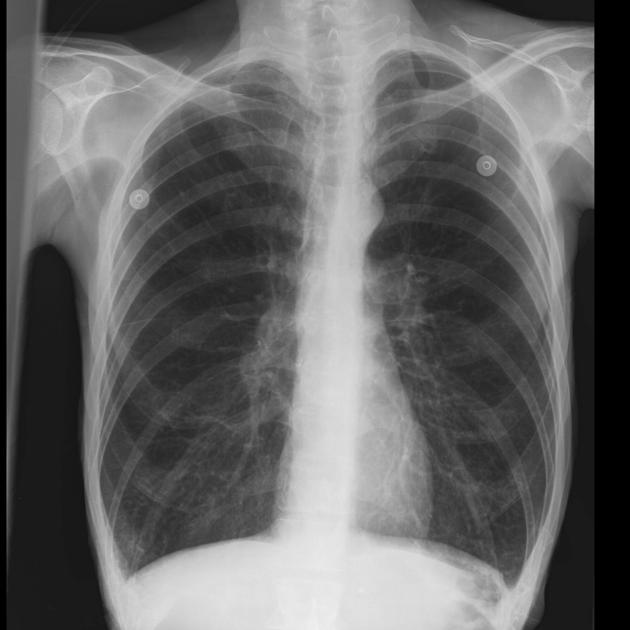 Chest x-ray shows typical example of hyperinflated lungs. Fields are hyperlucent and the is a flat diaphragm. More than 10 sets of posterior ribs are visible.